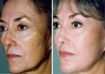 Non-Surgical Face Lift- Exoderm before 242995