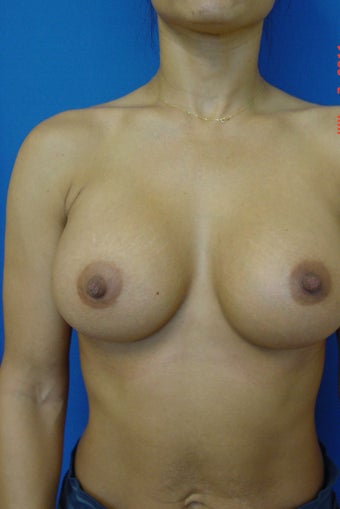 Breast Augmentation after 338418