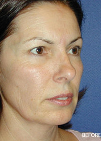 Cheek Implant Surgery before 328076