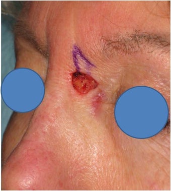 Repair of Mohs surgery defect on the left nose before 83242