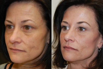 Non-surgical facial rejuvenation with Silikon-1000 and Botox. before 500583