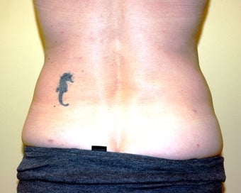 Ultrasonic assisted (Vaser) Liposuction of Flanks after 235766