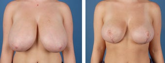 Breast Reduction after 355748