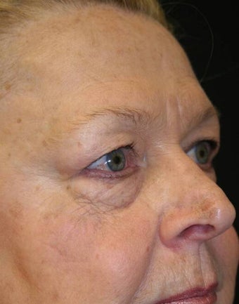Blepharoplasty before 165948