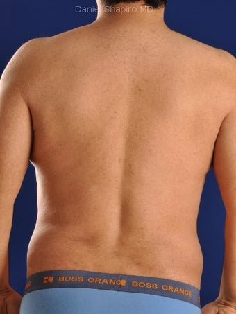 Vaser Hi Def Liposuction of chest, abdomen, back and flanks after 422695