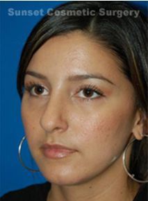 Chin Enhancement after 258287