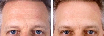 Botox Cosmetic before 253592