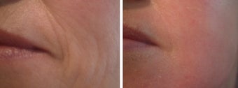 Green Peel to Wrinkles on cheek before 9839