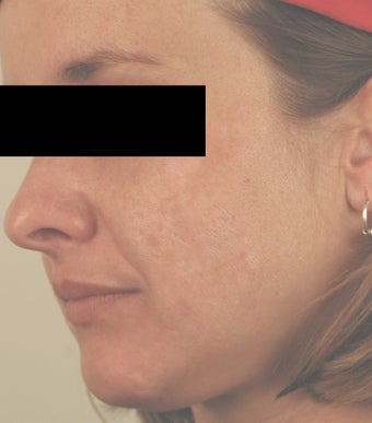 Laser Acne Scar Removal after 82946