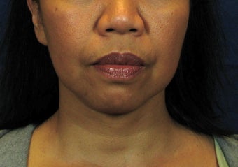 Chin Implant with Laser Facelift before 342973