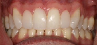 Cosmetic bonding and gum lift after 457034