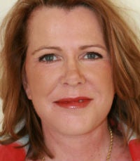 Facelift and laser resurfacing after 285972
