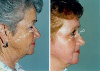 Non-Surgical Face Lift- Exoderm before 242974