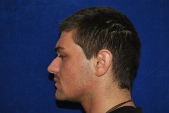 Endoscopic Brow Lift and Rhinoplasty 541221