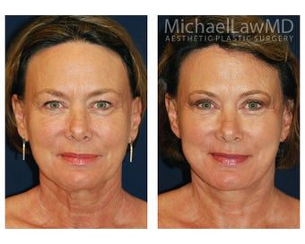 Facial Rejuvenation before 395488