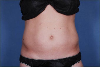 Liposonix before 448475