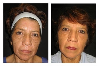 Non-Surgicial Facelift before 610411