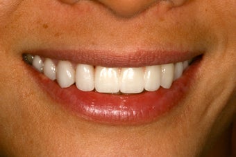 Ortho, dental implants, bone graft, gum graft, all porcelain veneers after 503156