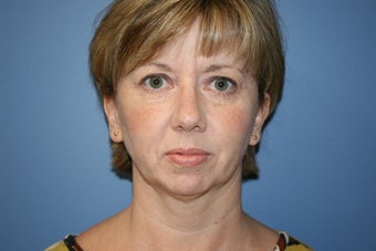 Chin implant before 78056