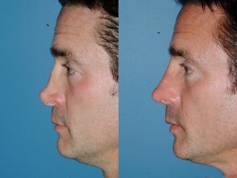 Revision rhinoplasty after 334286