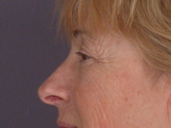 Eyelid Surgery before 306437
