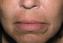 Juvederm before 336245