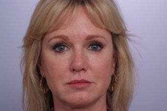 Endoscopic Forehead Lift after 250431