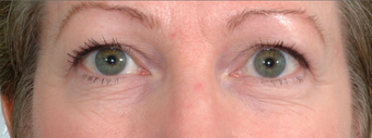 Laser Eyelid Surgery before 369077