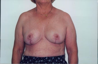 Breast Reduction after 218958