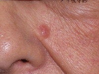 Basal Cell Carcinomas Excisions before 272095