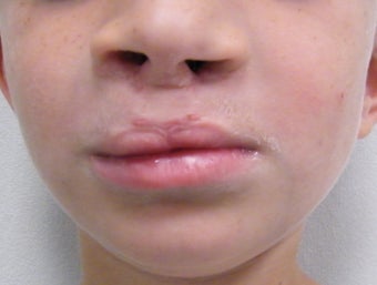 Cleft lip and palate after 594506