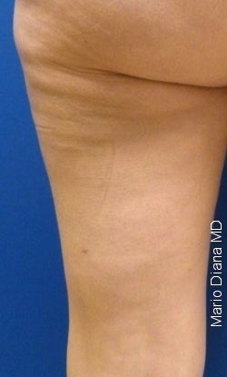 Cellulaze after 582367