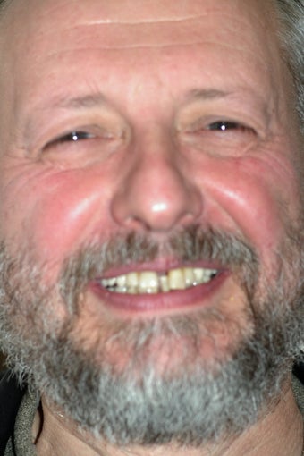 Full mouth reconstruction with dental implants before 364517
