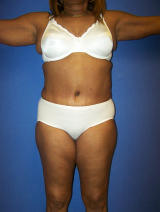 Massive Weight Loss Surgery after 131805