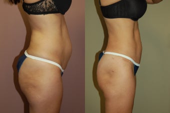 Tummy Tuck after 368140