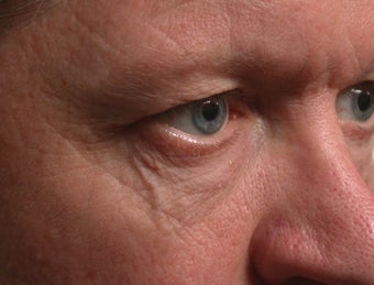 Sclerotherapy (eyelid) before 332441