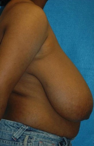 FEMMA-S Breast reduction and lift before 393389