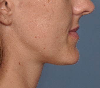 Chin Reduction 521959