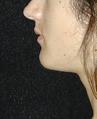 Chin Implant after 101323