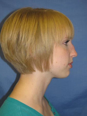 Rhinoplasty before 223693