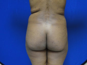 Brazilian Butt Lift/Fat Grafting Buttock Augmentation before 599828