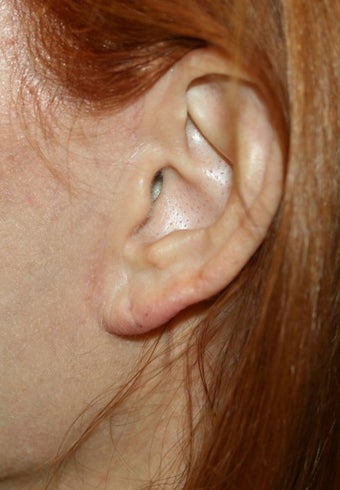 Earlobe filler after 393288