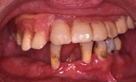 Dental Implants before 510566