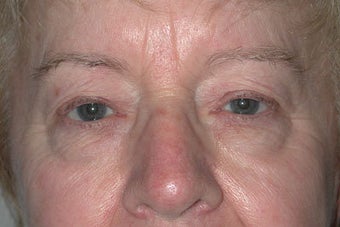 Upper and lower Blepharoplasty before 410972