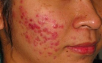 PDT for acne before 376122
