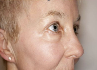 Deep/Active FX Laser Treatment after 282786