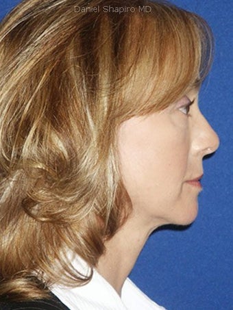 Cheeklift (Minifacelift), Bilateral Upper Blepharoplasty, Periorbital TCA Chemical Peel, Soft Tissue Filler to Nasolabial Folds after 249153