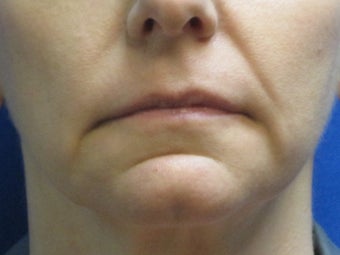 Juvederm chin and lip enhancement before 582251