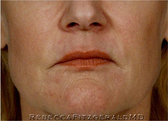 Sculptra, Botox, Juvederm and Restylane before 319352