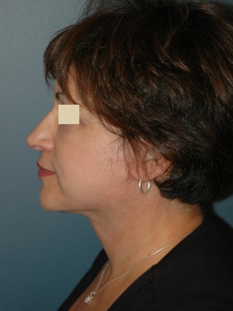 Facelift after 137056